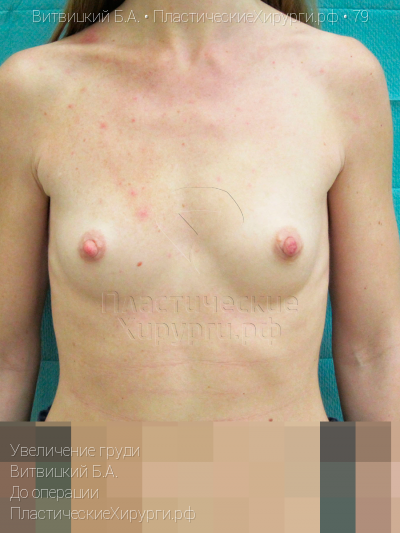 увеличение груди, пластический хирург Витвицкий Б. А., результат №79, ракурс 1, фото до операции