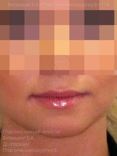 пластика нижней челюсти, пластический хирург Витвицкий Б. А., результат №114, ракурс 1, фото до операции