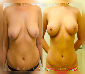 увеличение груди, результат №411, предварительное изображение до и после операции