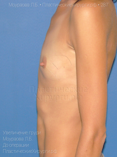 увеличение груди, пластический хирург Моураова Л. Б., результат №287, ракурс 3, фото до операции