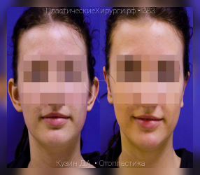 отопластика, результат №383, предварительное изображение до и после операции