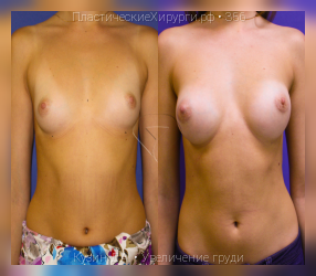 увеличение груди, результат №356, предварительное изображение до и после операции