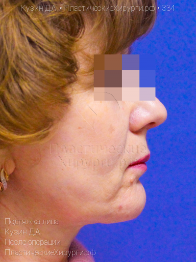 подтяжка лица, пластический хирург Кузин Д. А., результат №334, ракурс 3, фото после операции