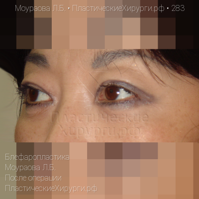 блефаропластика, пластический хирург Моураова Л. Б., результат №283, ракурс 2, фото после операции