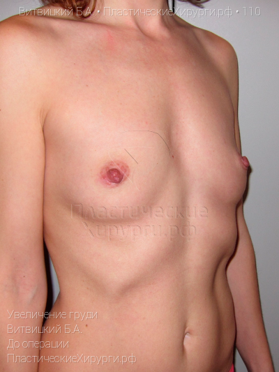 увеличение груди, пластический хирург Витвицкий Б. А., результат №110, ракурс 2, фото до операции