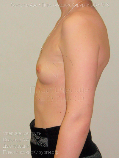 увеличение груди, пластический хирург Соколов А. А., результат №508, ракурс 5, фото до операции