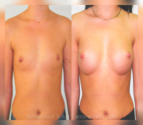увеличение груди, результат №39, предварительное изображение до и после операции