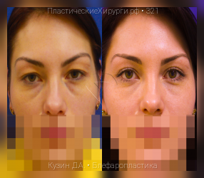 блефаропластика, результат №321, предварительное изображение до и после операции