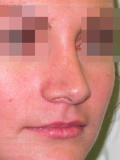 ринопластика, пластический хирург Витвицкий Б. А., результат №134, ракурс 2, фото после операции