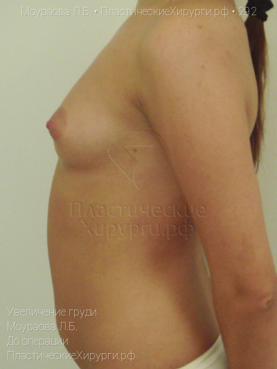 увеличение груди, пластический хирург Моураова Л. Б., результат №292, ракурс 3, фото до операции