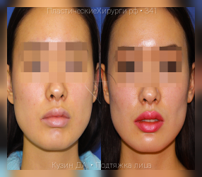 подтяжка лица, результат №341, предварительное изображение до и после операции