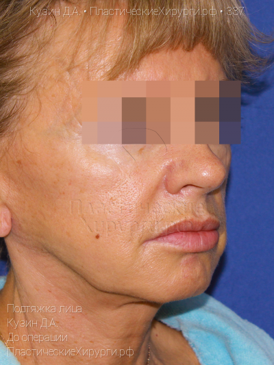 подтяжка лица, пластический хирург Кузин Д. А., результат №337, ракурс 2, фото до операции