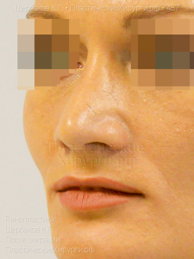 ринопластика, пластический хирург Щербаков К. Г., результат №487, ракурс 4, фото после операции