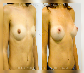увеличение груди, результат №413, предварительное изображение до и после операции