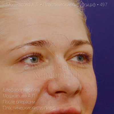 блефаропластика, пластический хирург Мошкалова А. Л., результат №497, ракурс 2, фото после операции
