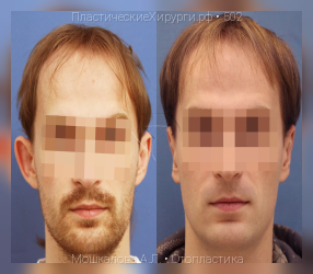 отопластика, результат №502, предварительное изображение до и после операции