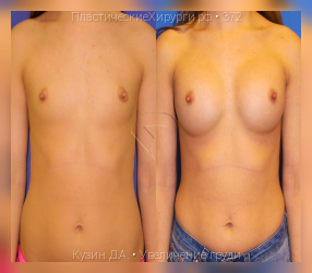 увеличение груди, результат №372, предварительное изображение до и после операции