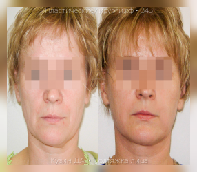 подтяжка лица, результат №343, предварительное изображение до и после операции