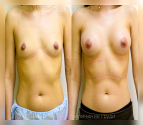 увеличение груди, результат №447, предварительное изображение до и после операции