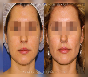 подтяжка лица, результат №342, предварительное изображение до и после операции