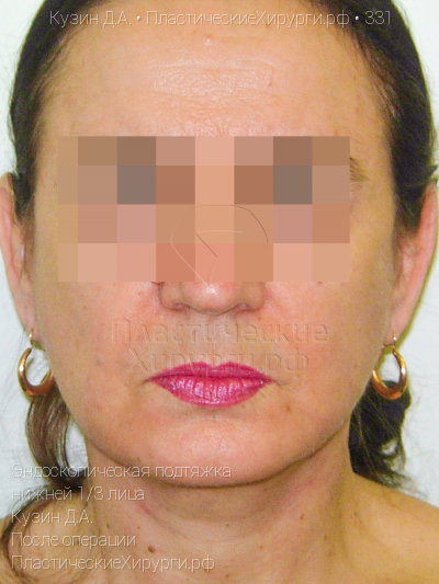 эндоскопическая подтяжка нижней трети лица, пластический хирург Кузин Д. А., результат №331, ракурс 1, фото после операции