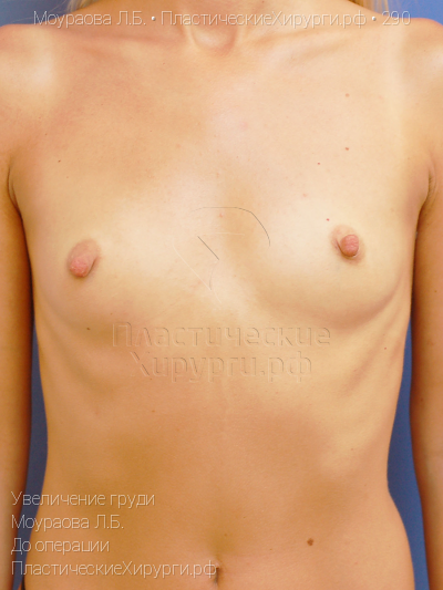 увеличение груди, пластический хирург Моураова Л. Б., результат №290, ракурс 1, фото до операции