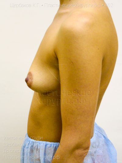 увеличение груди, пластический хирург Щербаков К. Г., результат №452, ракурс 5, фото до операции