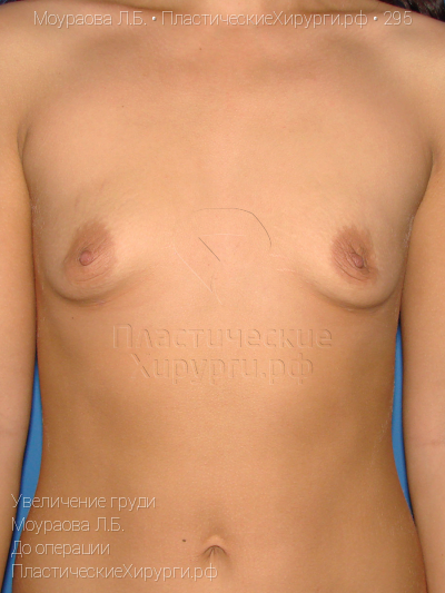 увеличение груди, пластический хирург Моураова Л. Б., результат №295, ракурс 1, фото до операции
