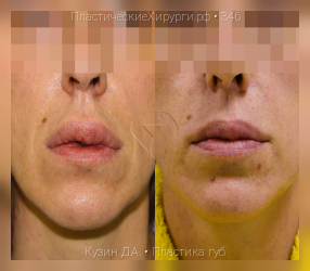 пластика губ, результат №346, предварительное изображение до и после операции