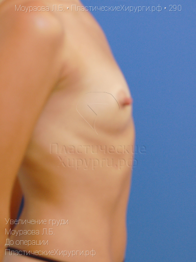 увеличение груди, пластический хирург Моураова Л. Б., результат №290, ракурс 3, фото до операции