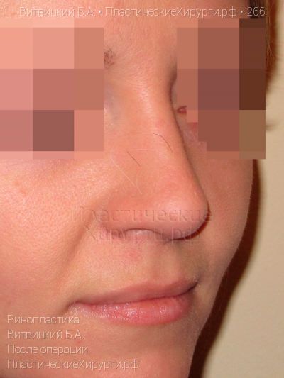 ринопластика, пластический хирург Витвицкий Б. А., результат №266, ракурс 2, фото после операции