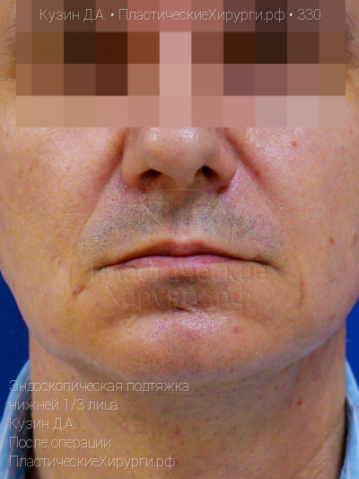 эндоскопическая подтяжка нижней трети лица, пластический хирург Кузин Д. А., результат №330, ракурс 1, фото после операции