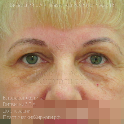 блефаропластика, пластический хирург Витвицкий Б. А., результат №16, ракурс 1, фото до операции