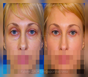 блефаропластика, результат №323, предварительное изображение до и после операции