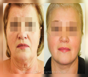 подтяжка лица, результат №344, предварительное изображение до и после операции