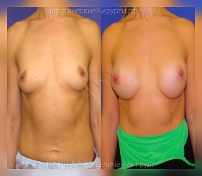 увеличение груди, результат №367, предварительное изображение до и после операции