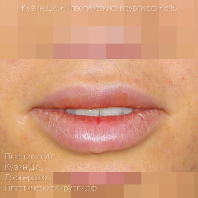 пластика губ, пластический хирург Кузин Д. А., результат №345, ракурс 1, фото до операции