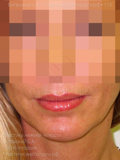 пластика нижней челюсти, пластический хирург Витвицкий Б. А., результат №115, ракурс 1, фото после операции
