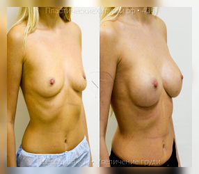 увеличение груди, результат №425, предварительное изображение до и после операции