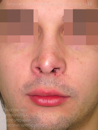 ринопластика, пластический хирург Витвицкий Б. А., результат №193, ракурс 1, фото после операции