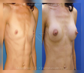 увеличение груди, результат №287, предварительное изображение до и после операции