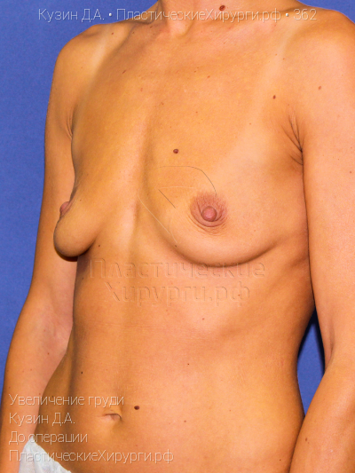 увеличение груди, пластический хирург Кузин Д. А., результат №362, ракурс 2, фото до операции
