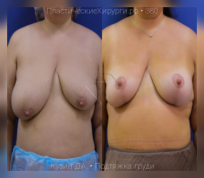 подтяжка груди, результат №380, предварительное изображение до и после операции