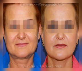 подтяжка лица, результат №336, предварительное изображение до и после операции