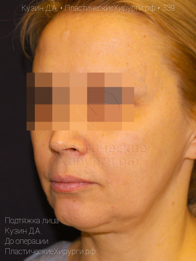 подтяжка лица, пластический хирург Кузин Д. А., результат №339, ракурс 2, фото до операции