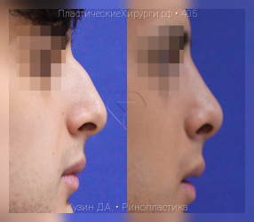 ринопластика, результат №405, предварительное изображение до и после операции