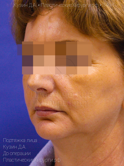 подтяжка лица, пластический хирург Кузин Д. А., результат №340, ракурс 2, фото до операции