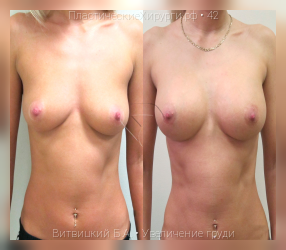 увеличение груди, результат №42, предварительное изображение до и после операции