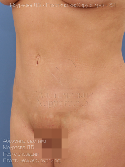 абдоминопластика, пластический хирург Моураова Л. Б., результат №281, ракурс 4, фото после операции