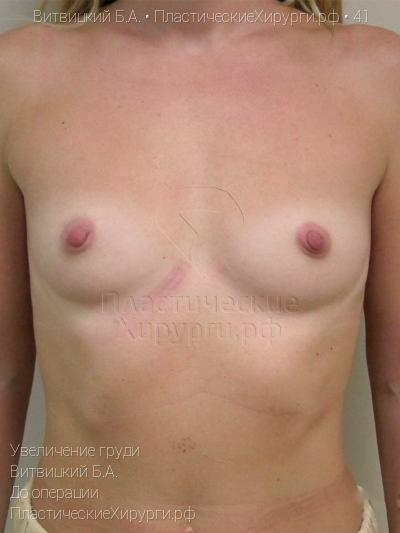увеличение груди, пластический хирург Витвицкий Б. А., результат №41, ракурс 1, фото до операции